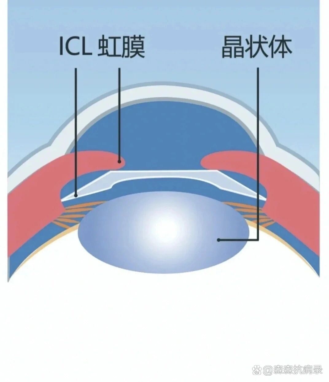 医生肯定和你说icl是什么什么高科技什么的,可以在你眼睛里放多少年