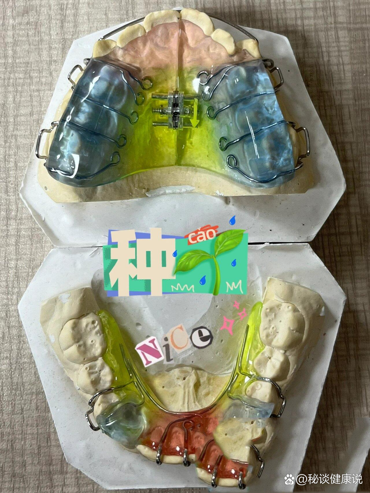 下颌后缩矫正—双颌矫治器(twin-block)7515