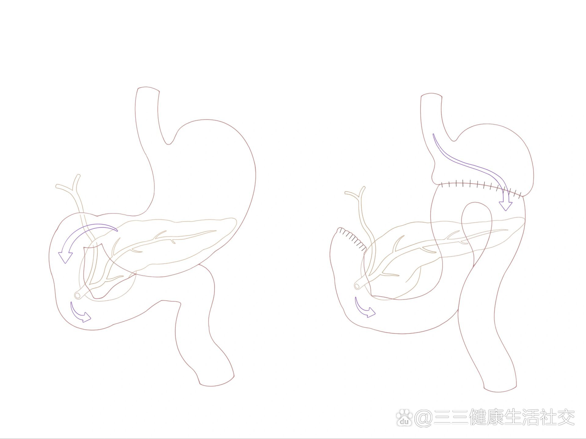 医学插画笔记‖胃大部切除术