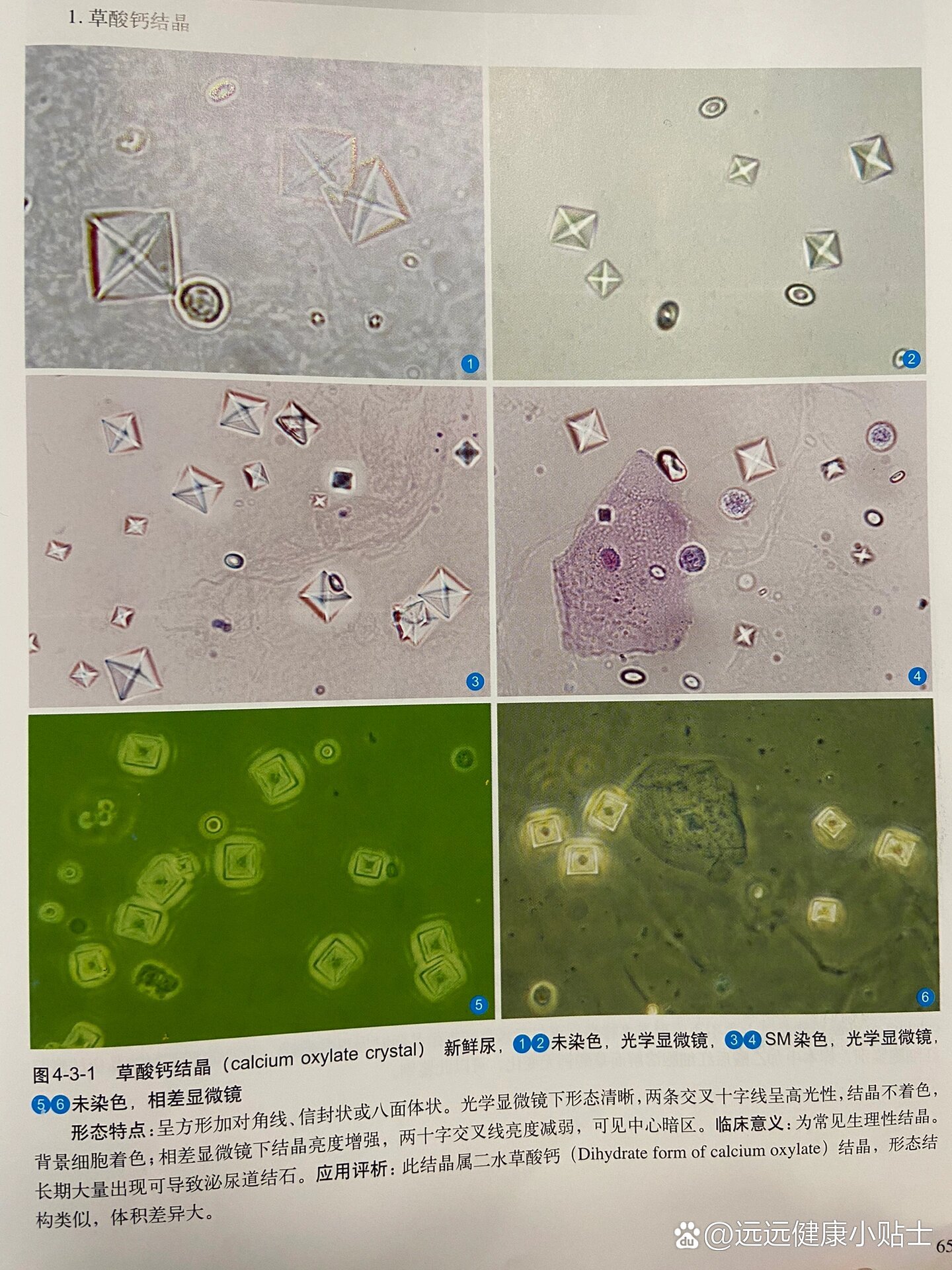 尿液中的结晶图片