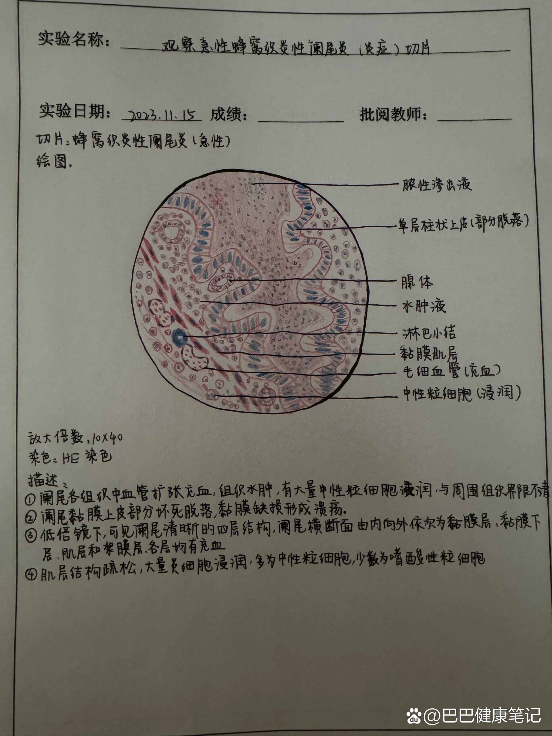 病理实验阑尾炎手绘图图片