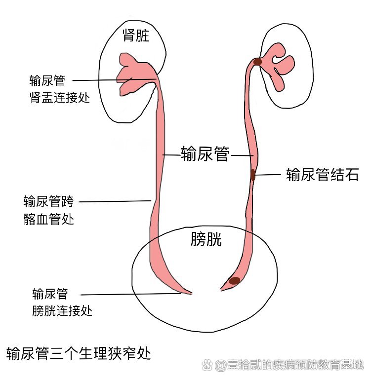 尿道的三个狭窄图片