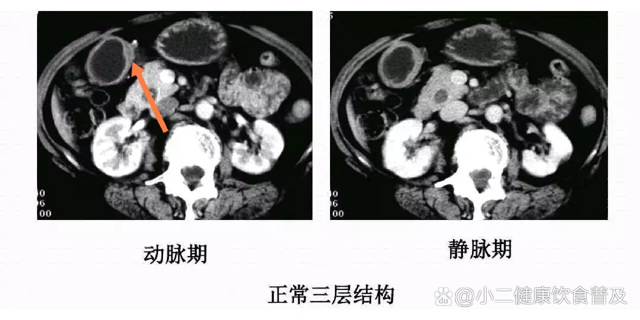 胃的ct横断面解剖