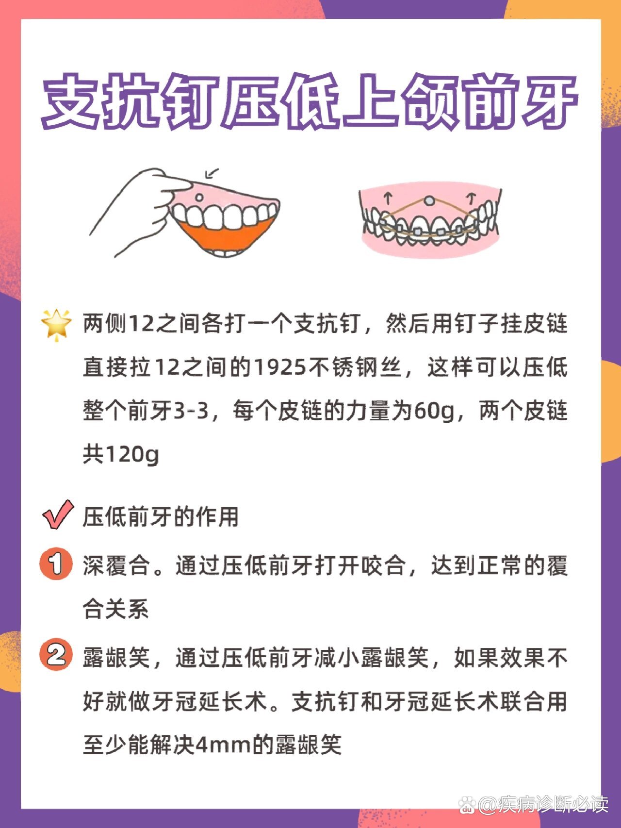 支抗钉压低上颌前牙
