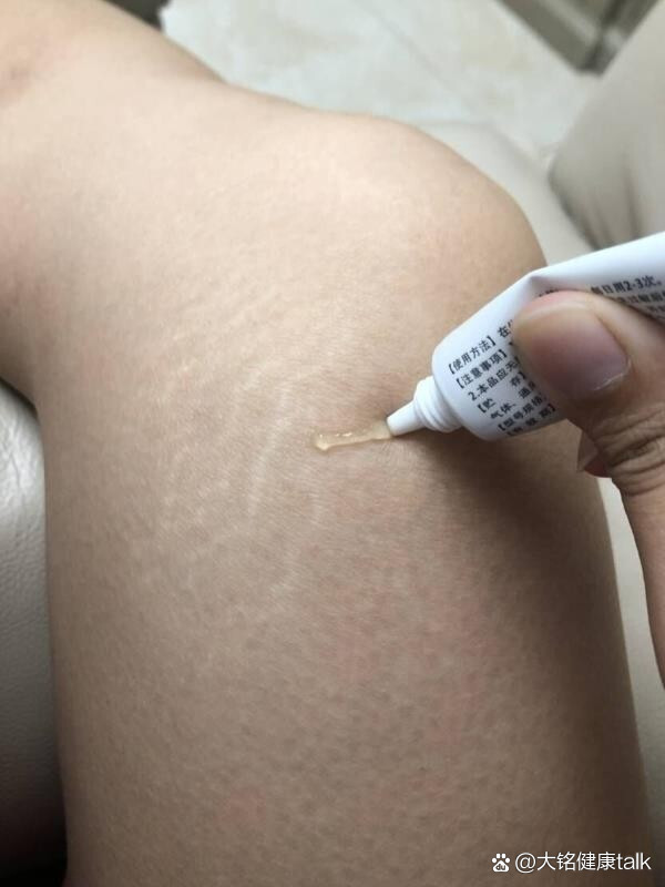 图中这个丑丑的肥胖纹,就长在我的膝盖上