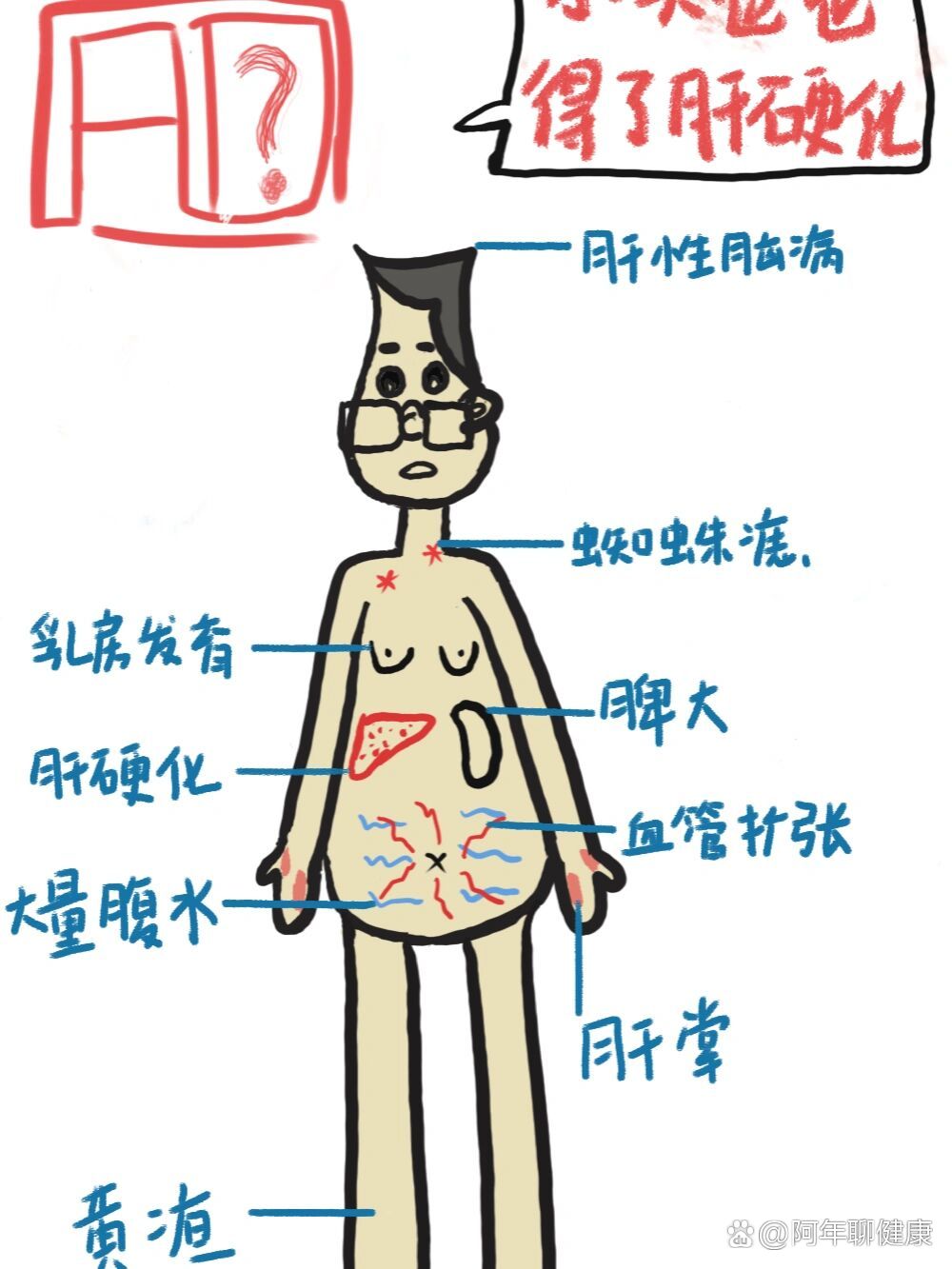 肝硬化发病机制示意图图片