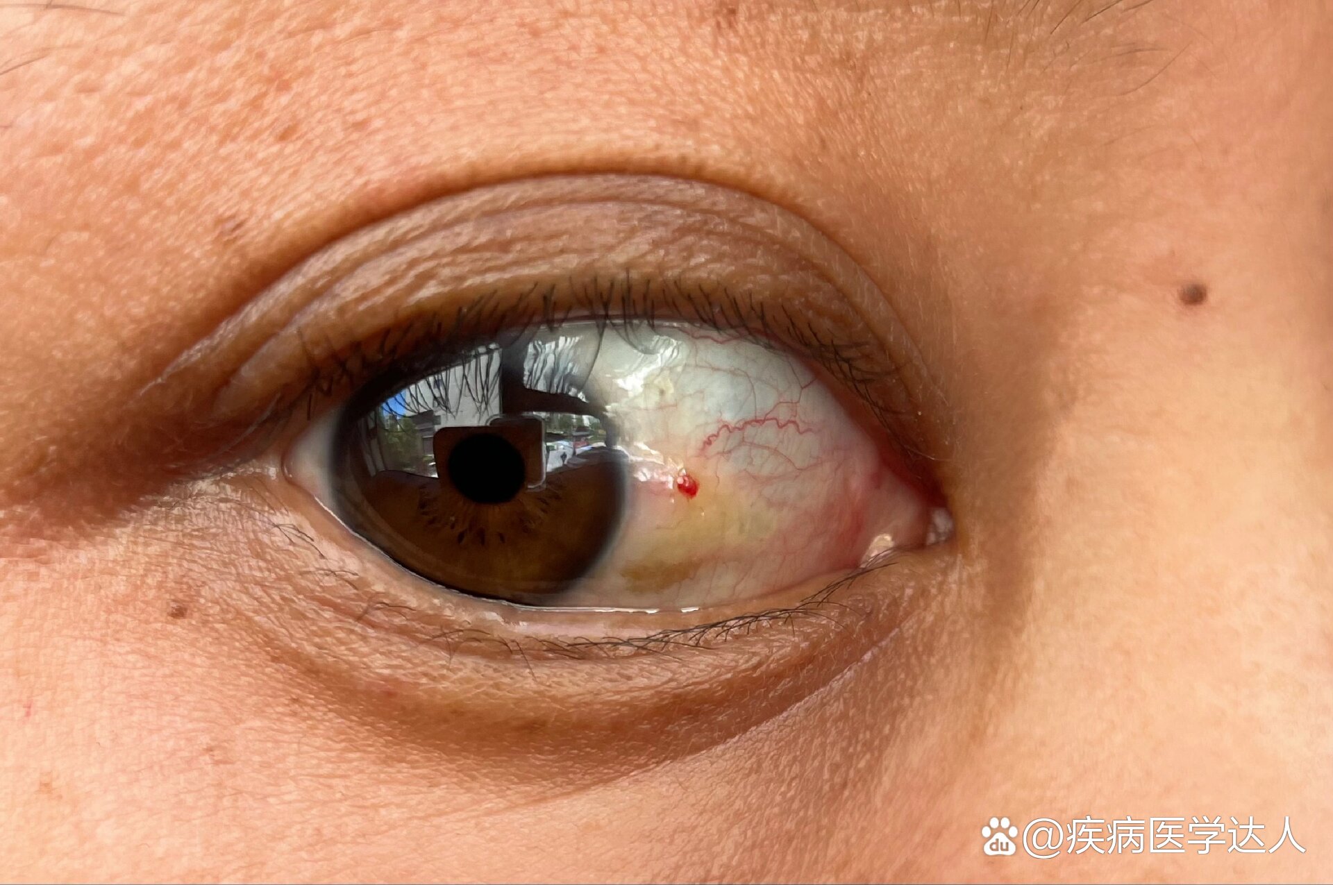 眼球上长长了个红点是怎么回事?