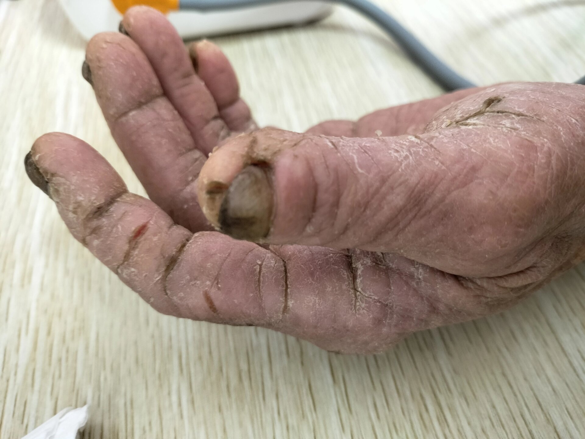 奶奶手老是开裂,怎么办?