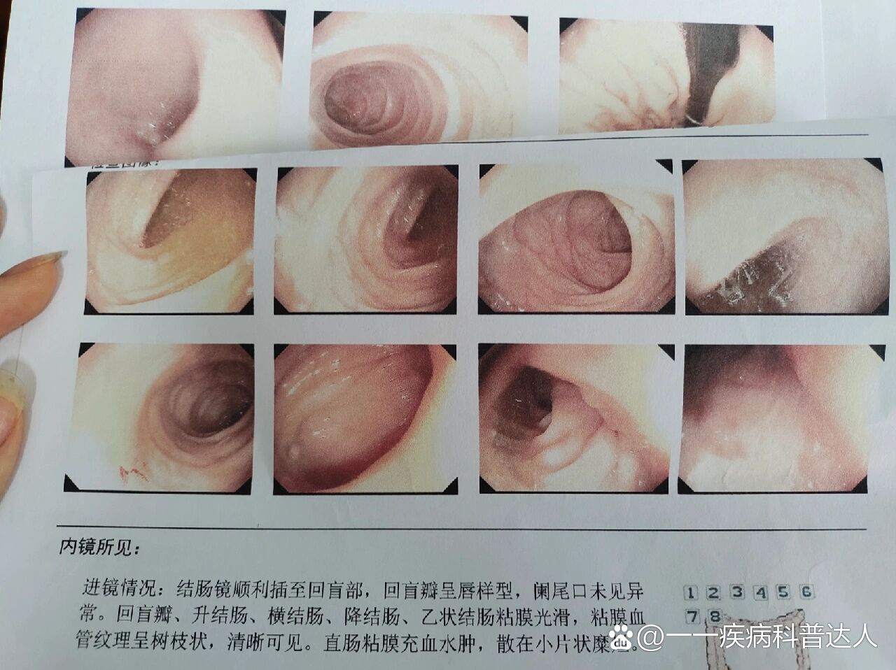 医院无痛胃肠镜攻略!