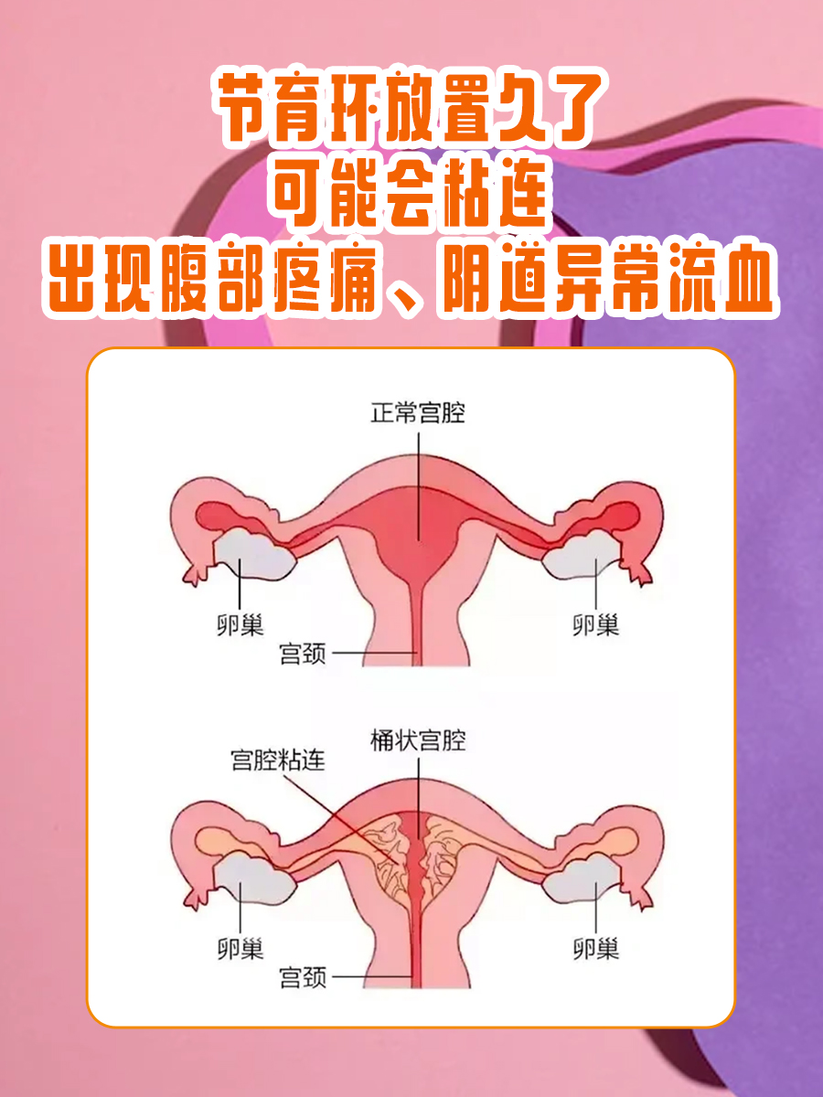 原来取环还有时间讲究 快来了解