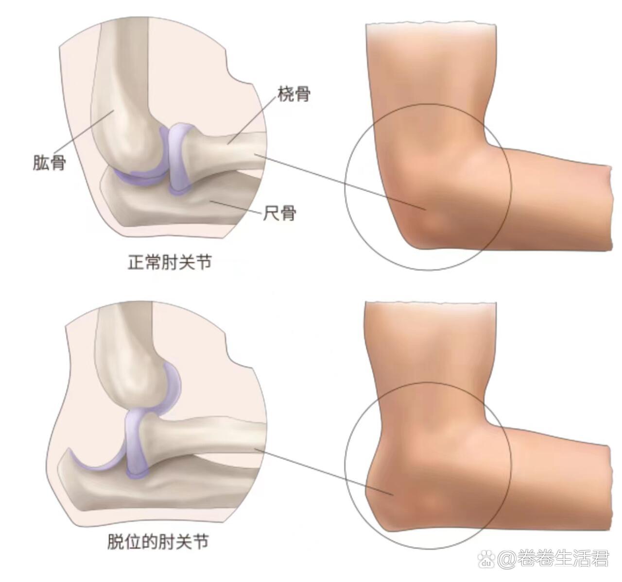 关于肘关节脱位你了解多少