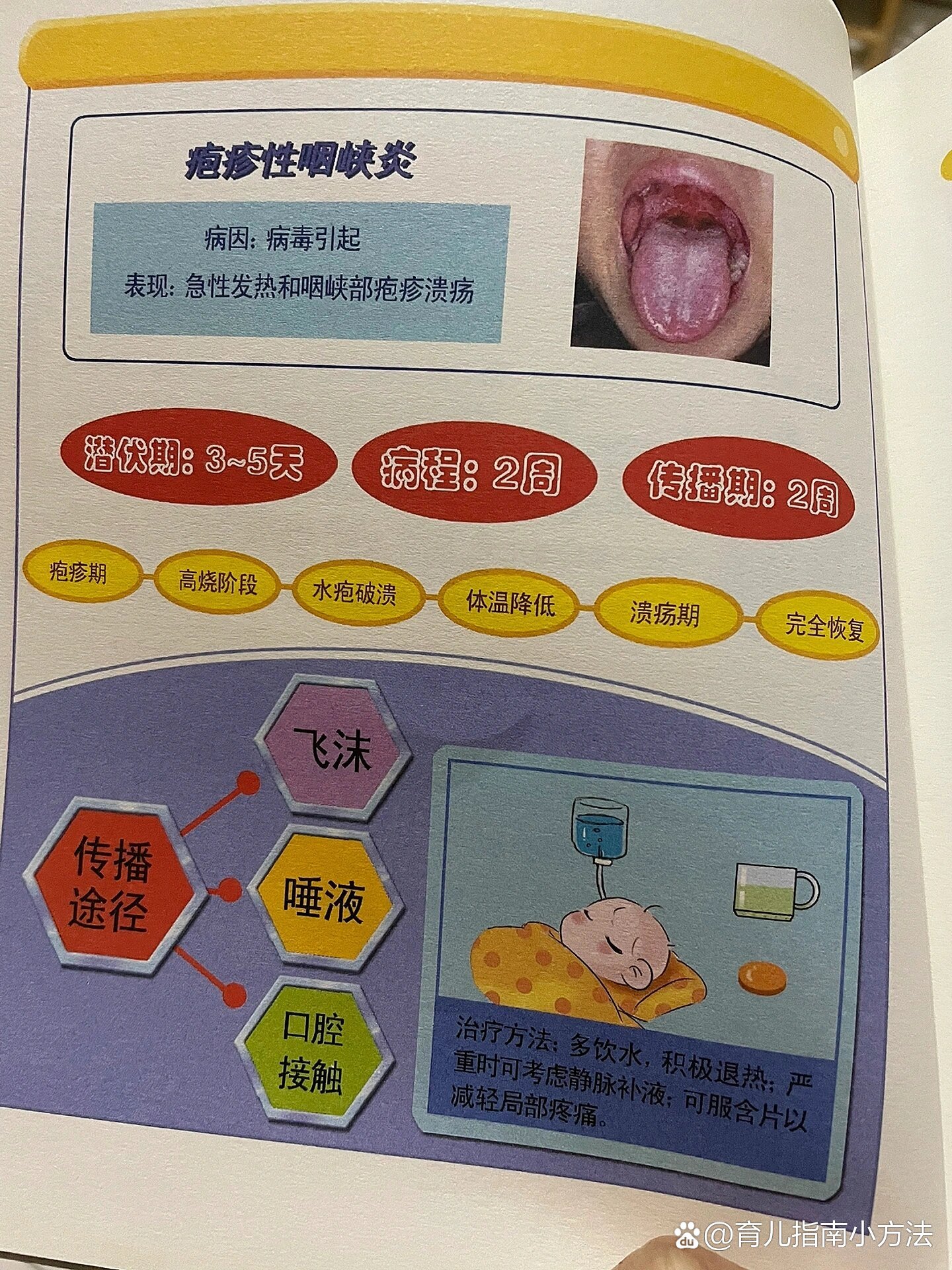 儿童疱疹性咽峡炎如何处理?