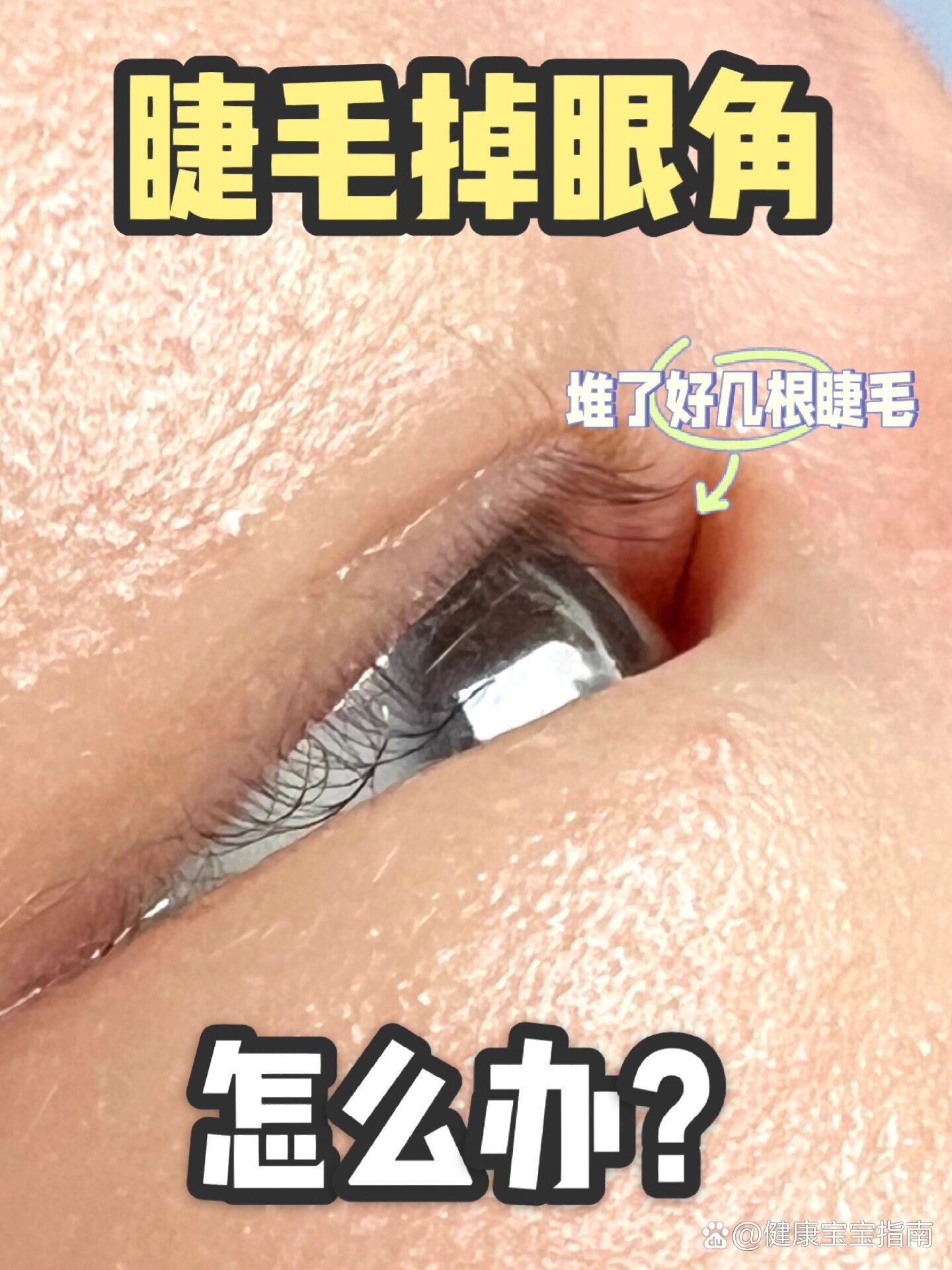宝宝掉了的眼睫毛老是堆在眼角,要怎么办?