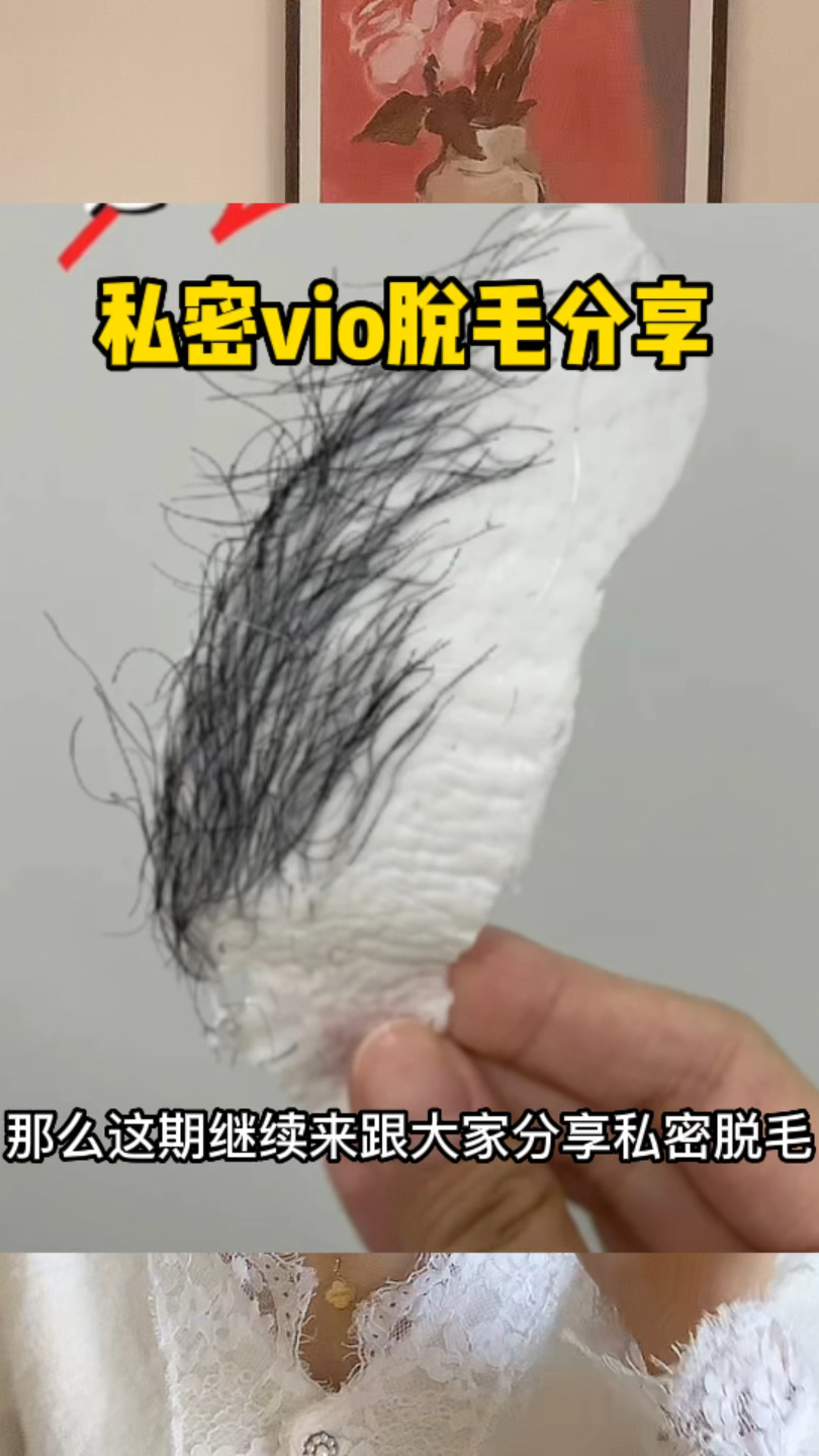 比基尼激光脱毛中的vio脱毛是什么意思?