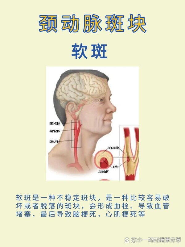 颈动脉斑块的位置图片