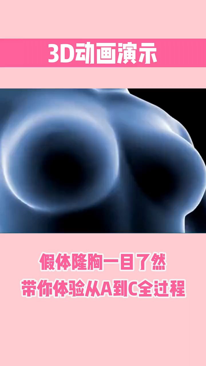 3d动画演示假体隆胸过程,假体丰胸手术全过程动画