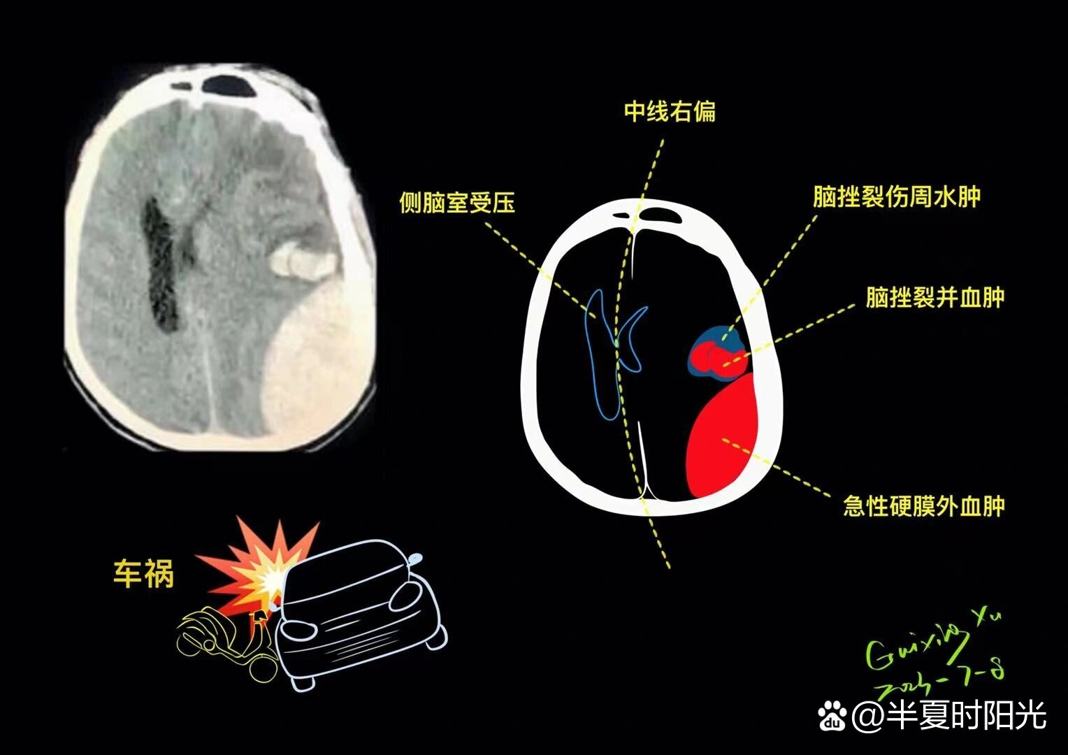 血肿怎么消得快图片