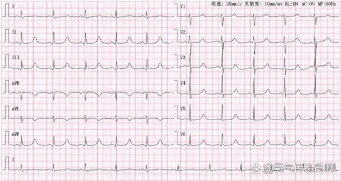 bpm者,qt间期正常值为360～440 ms,>440 ms为qt间期延长(即长qt间期)