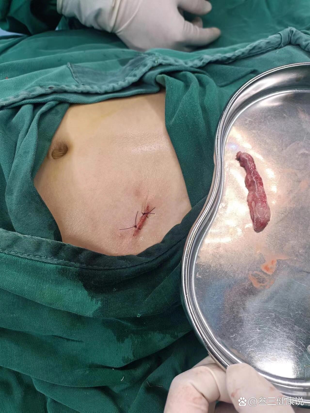 8岁的小帅哥得了急性阑尾炎,开放手术1.5cm的切口完美解决