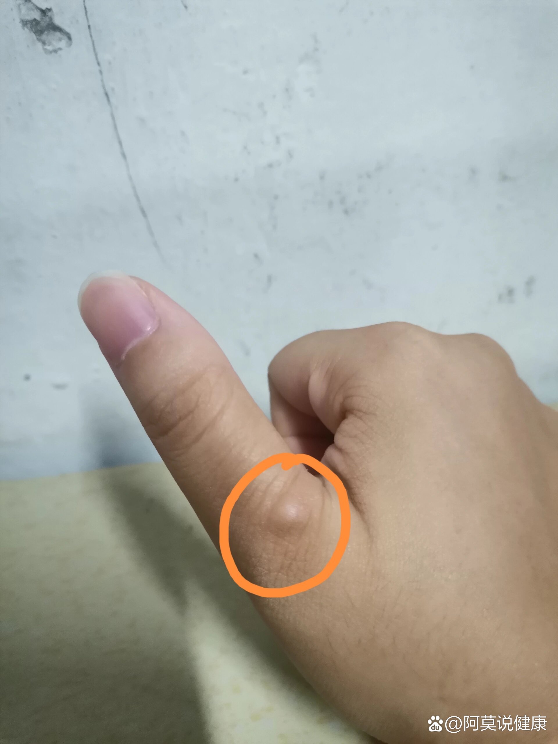 长了个小疙瘩,也没感觉不痛不痒,突然长出来的前几天手这里发黑