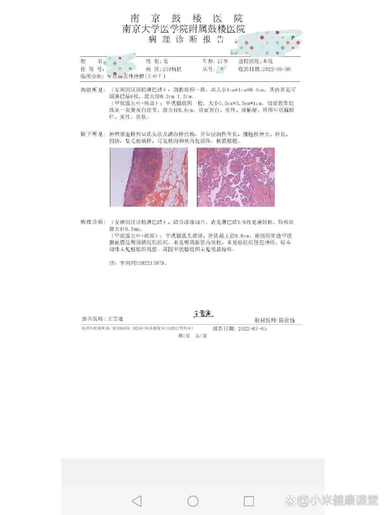 甲状腺癌术后大病理淋巴结转移一个