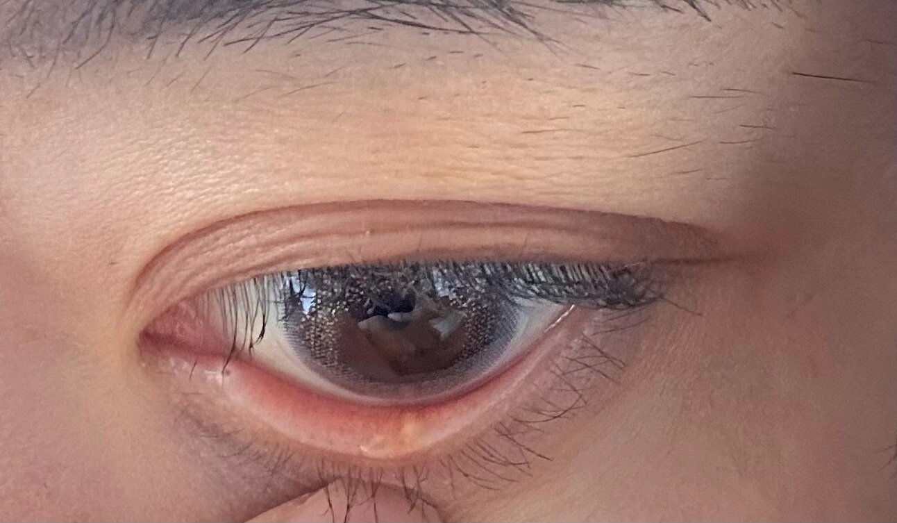 下眼睑长了一颗透明凸起