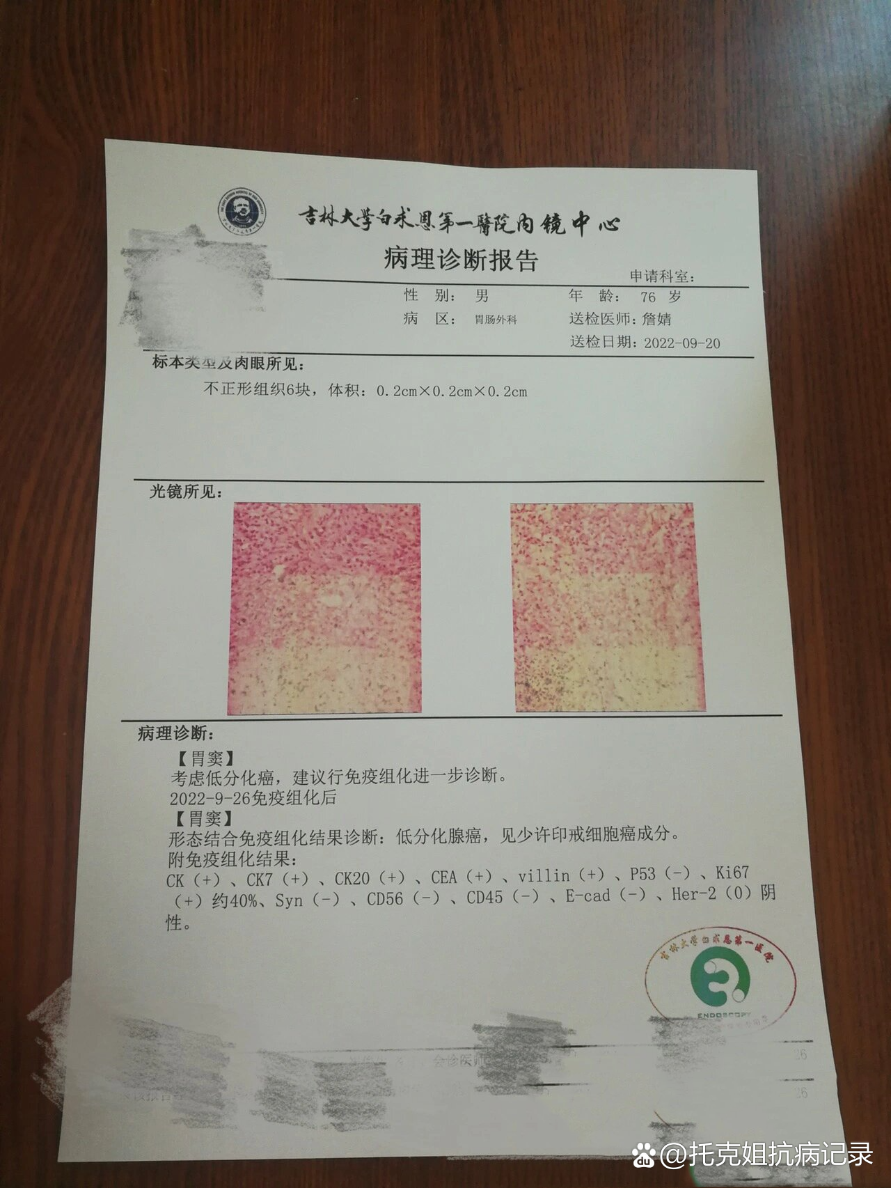 确诊胃癌晚期的第21天