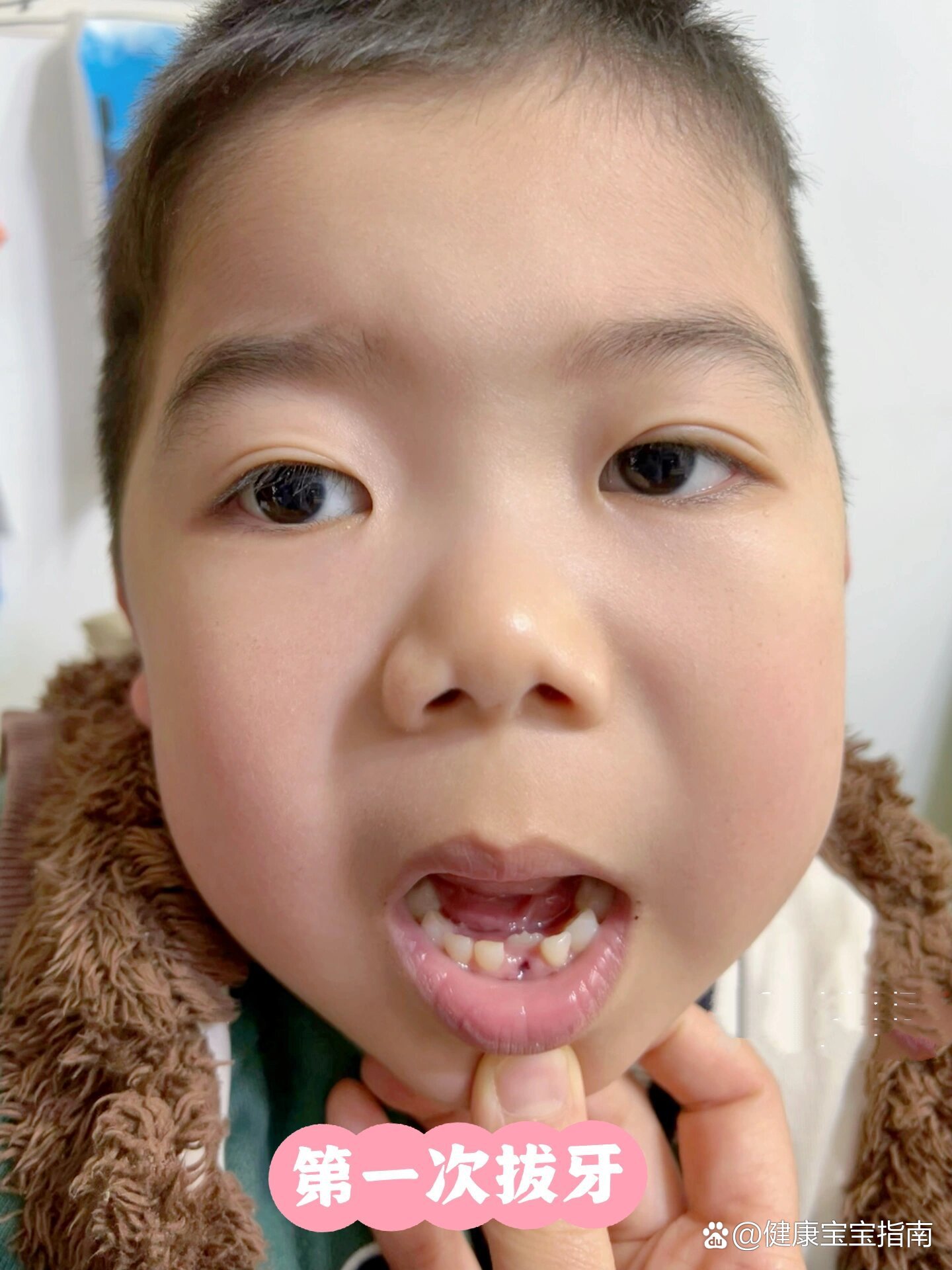  br>有经验的朋友们,乳牙没掉新门牙长出来了,现在拔掉乳牙,新牙能长