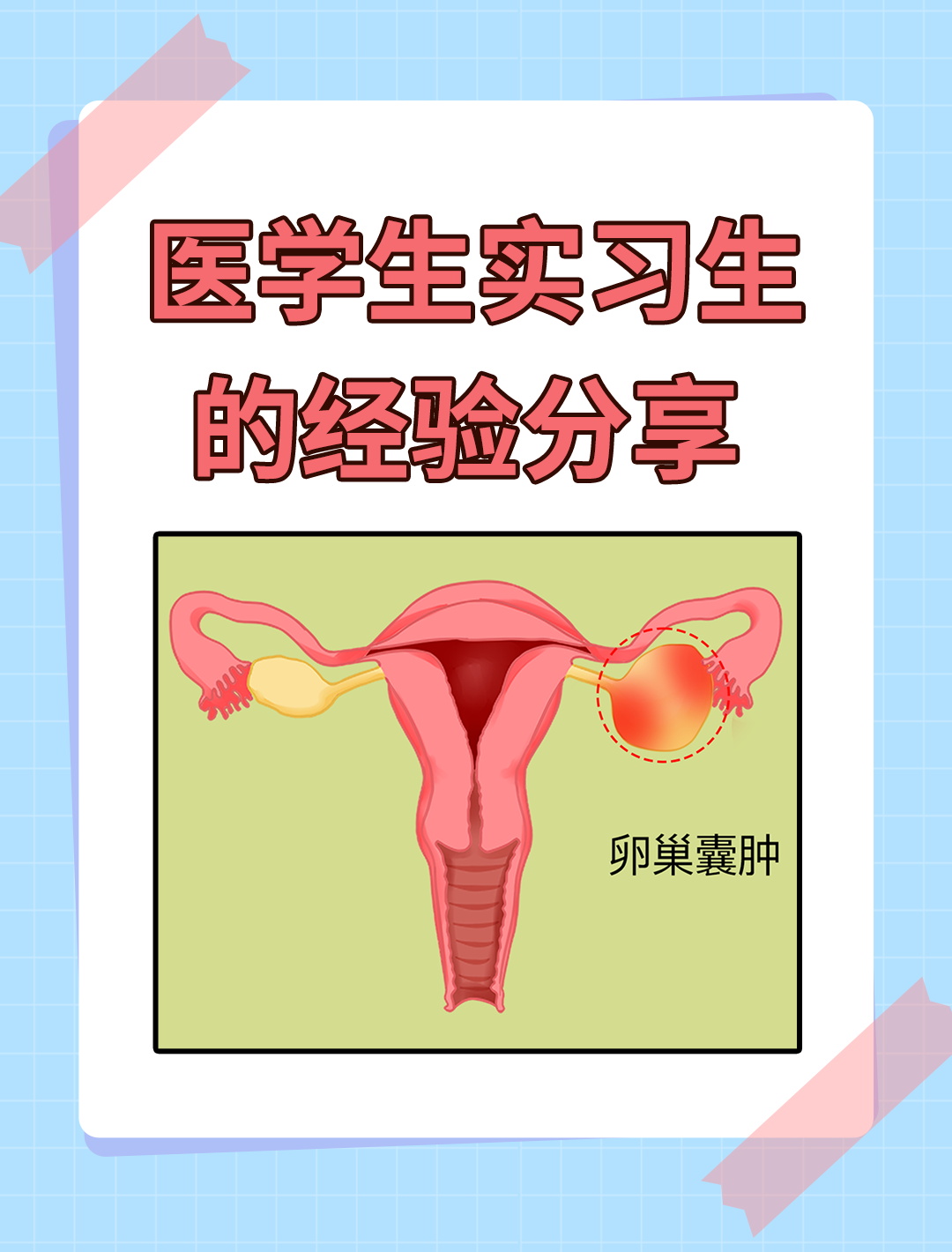 卵巢囊肿谜团解析:会自我消失吗?