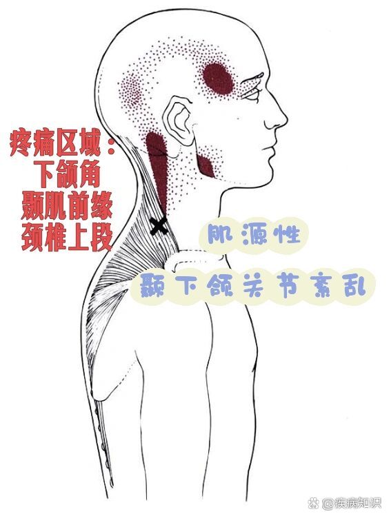 颞肌疼痛图片