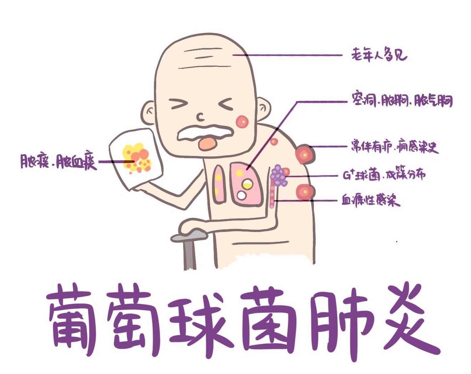 葡萄球菌肺炎
