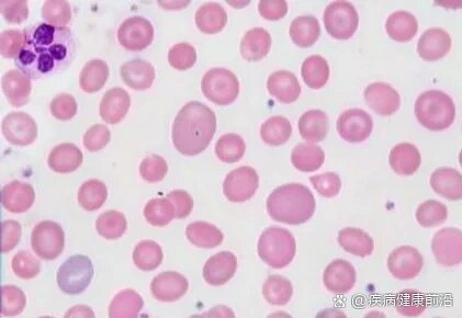 大细胞性贫血(基础解析)