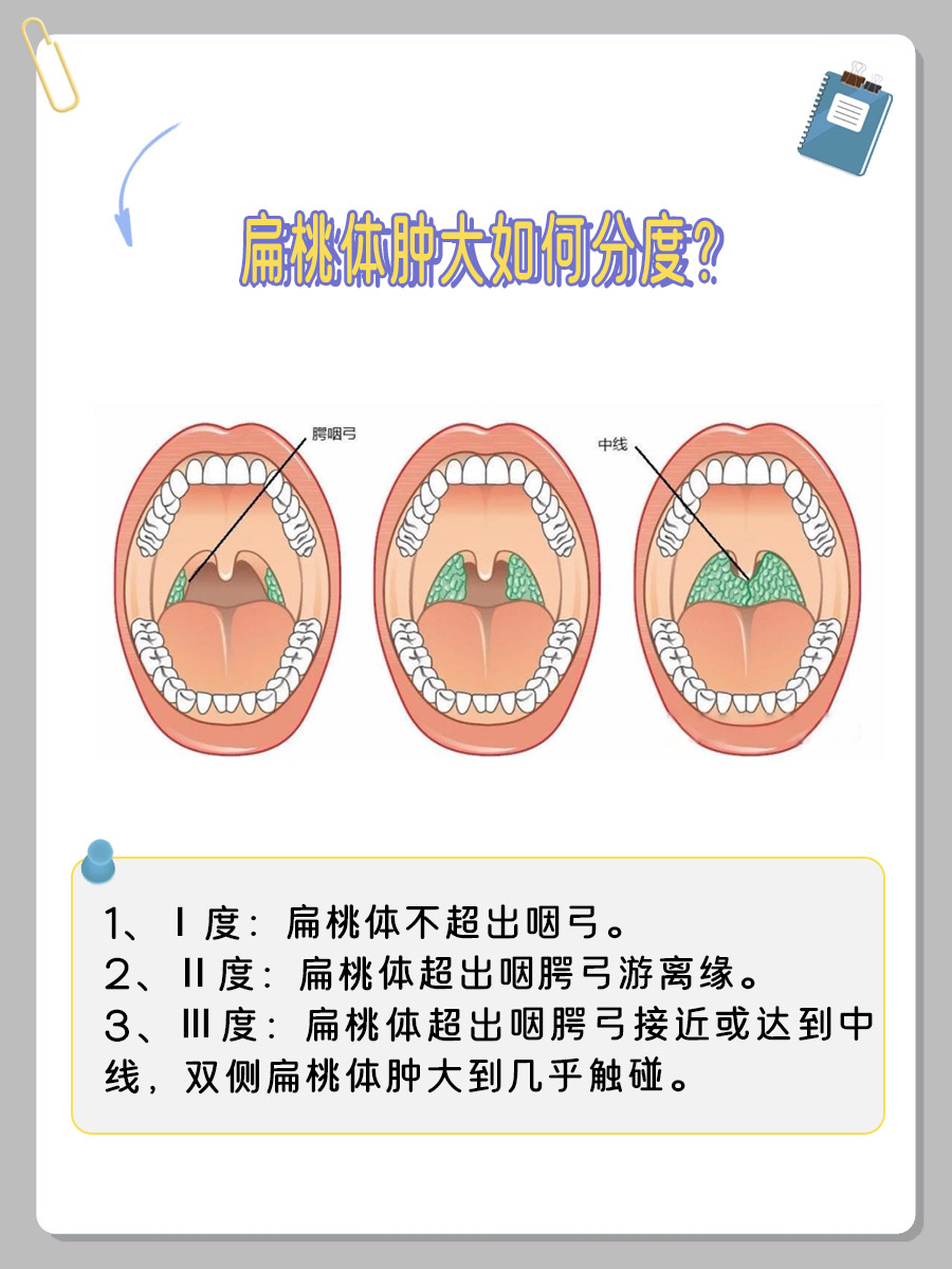 舌腭弓和咽腭弓图片