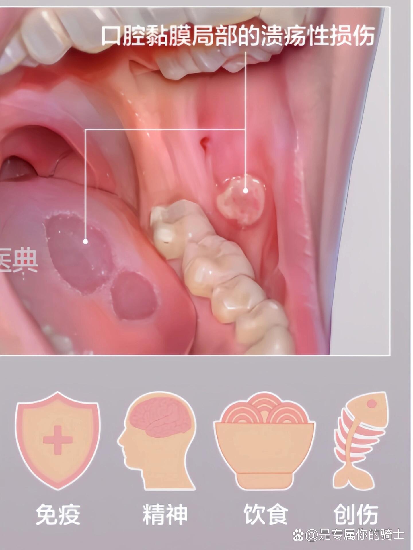 口腔溃疡好得快图片