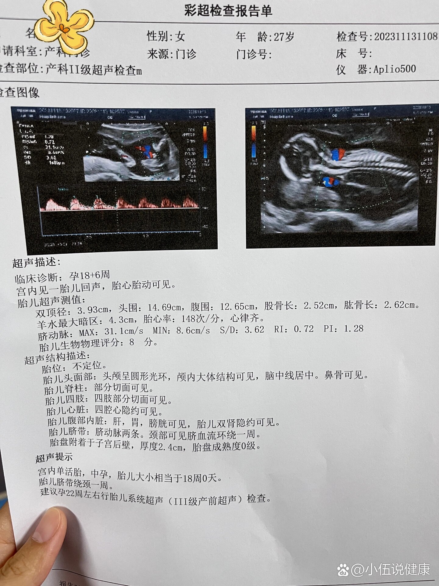 nt鼻骨显示不清的孕妈不用太担心