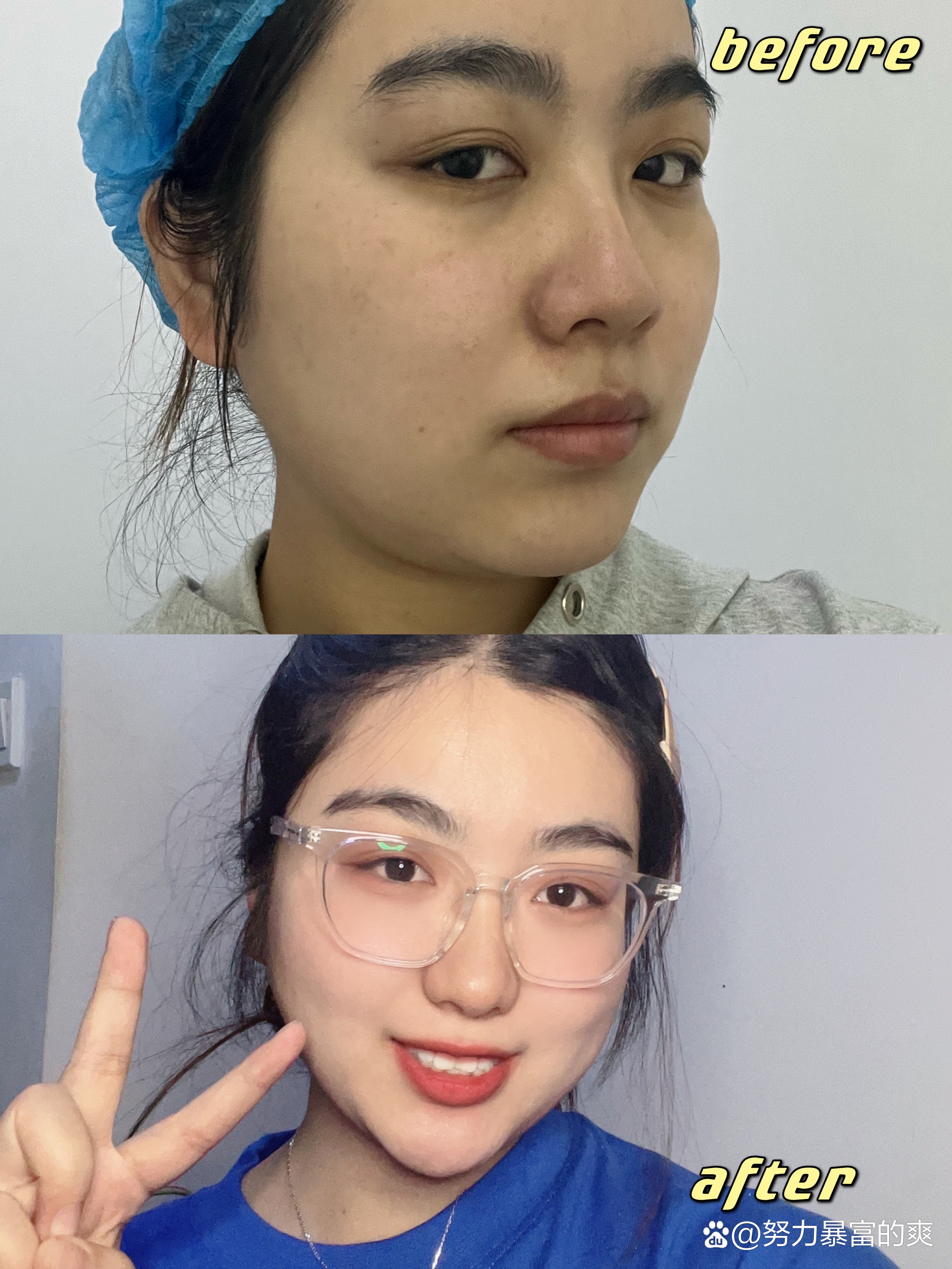 光子嫩肤的功效与副作用?