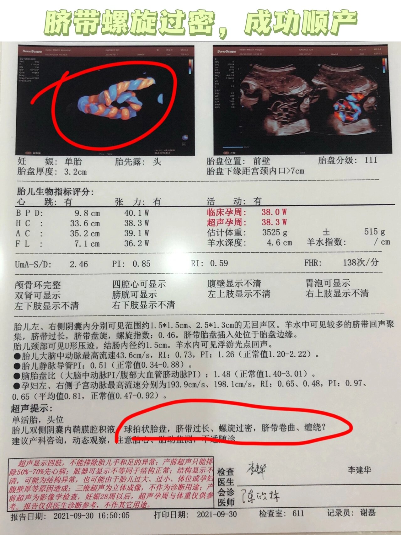 脐带绕颈是有区别的,脐带螺旋危险6015指数敲级高!