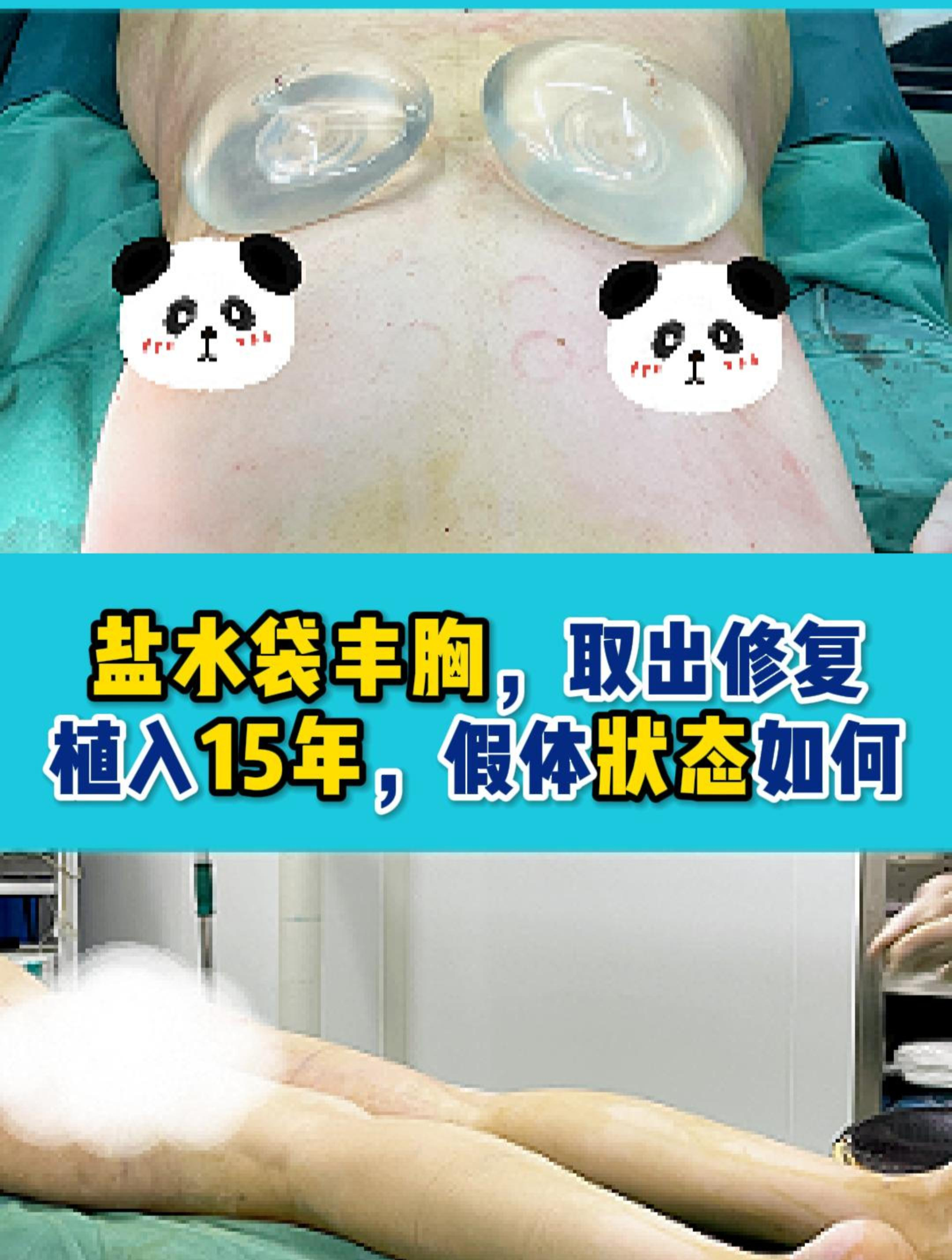 胸假体,要取出修复,假体胸内渗漏!