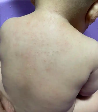 热痱子的症状图片