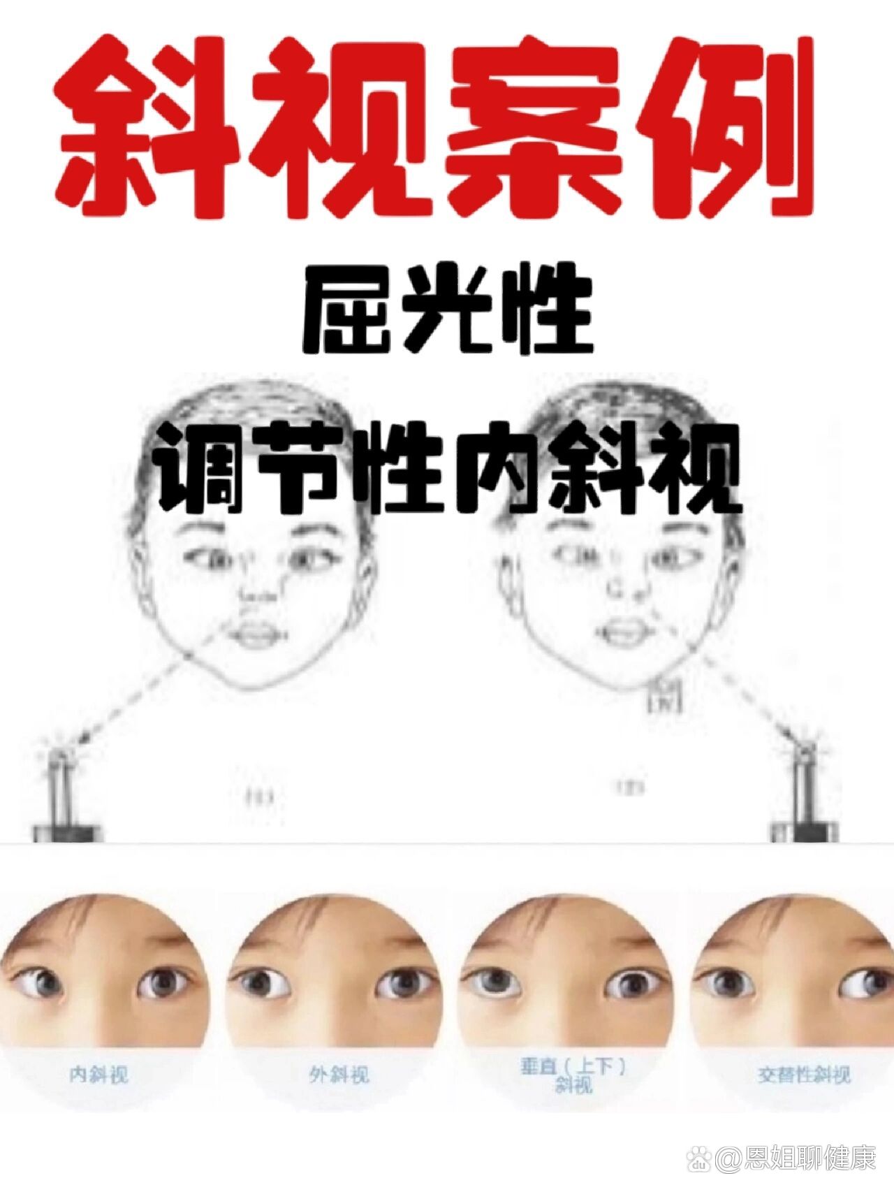 西安小儿斜视案例|屈光性调节性内斜视