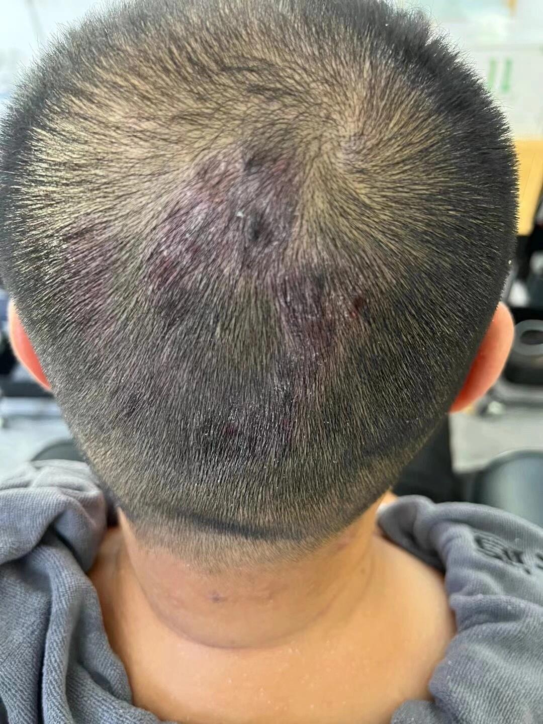 困扰这兄弟多年的头皮癣