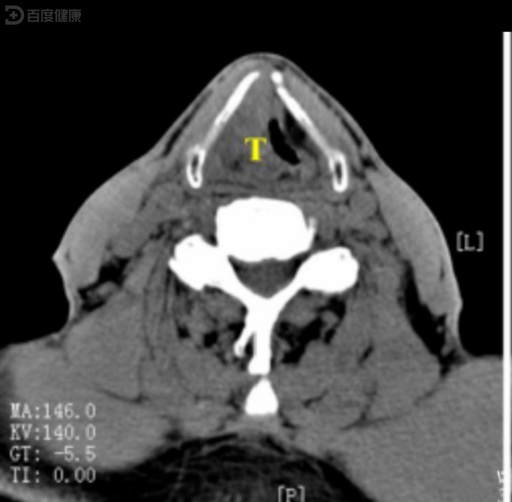 62岁男性患者患声门上型喉癌经过手术,放疗后效果明显