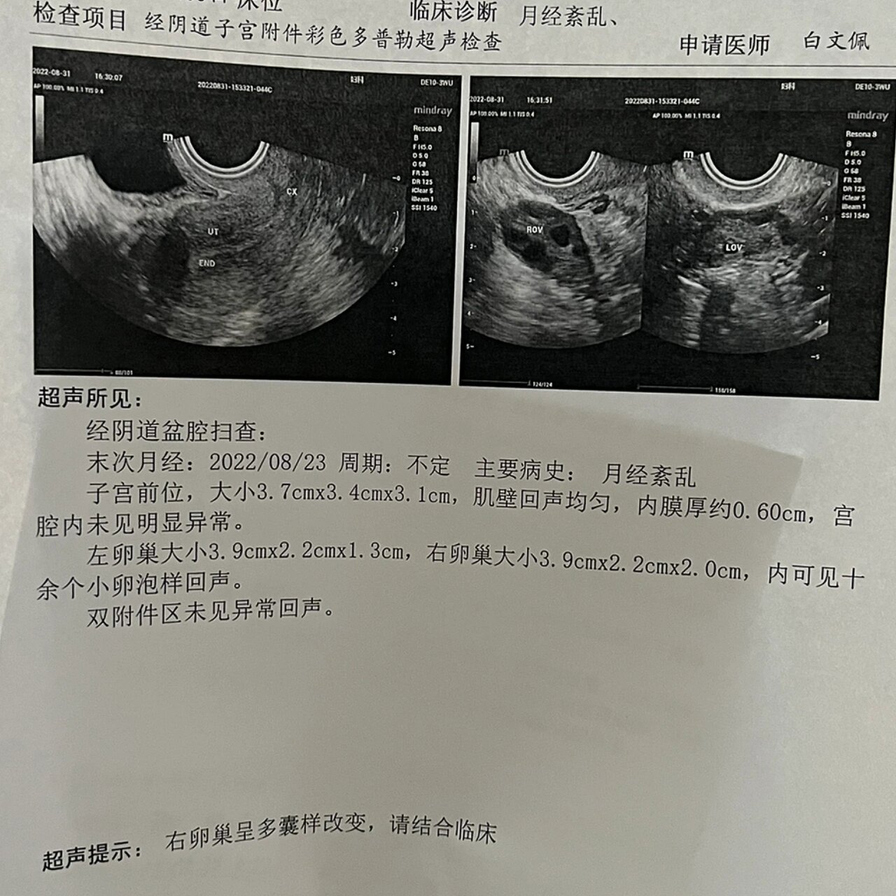 多卵巢多囊吃优思悦_卵巢多囊吃优思悦第三个月还有褐色分泌物