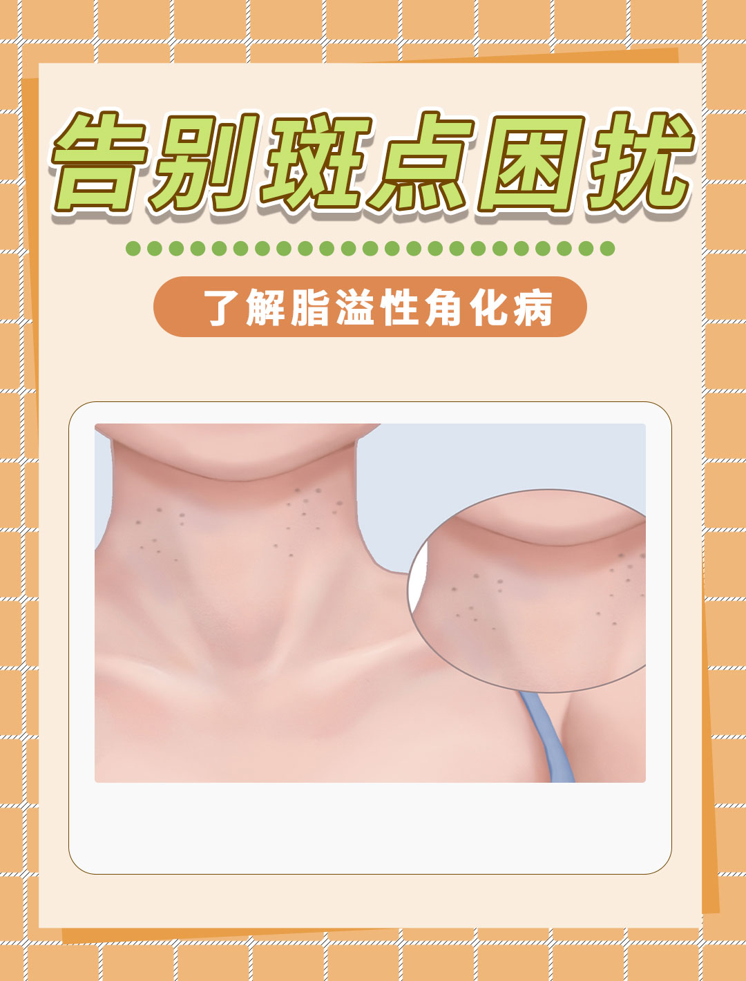 脂溢性角化病,皮肤的"小秘密"