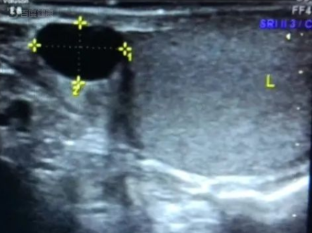 附睾囊肿超声图片
