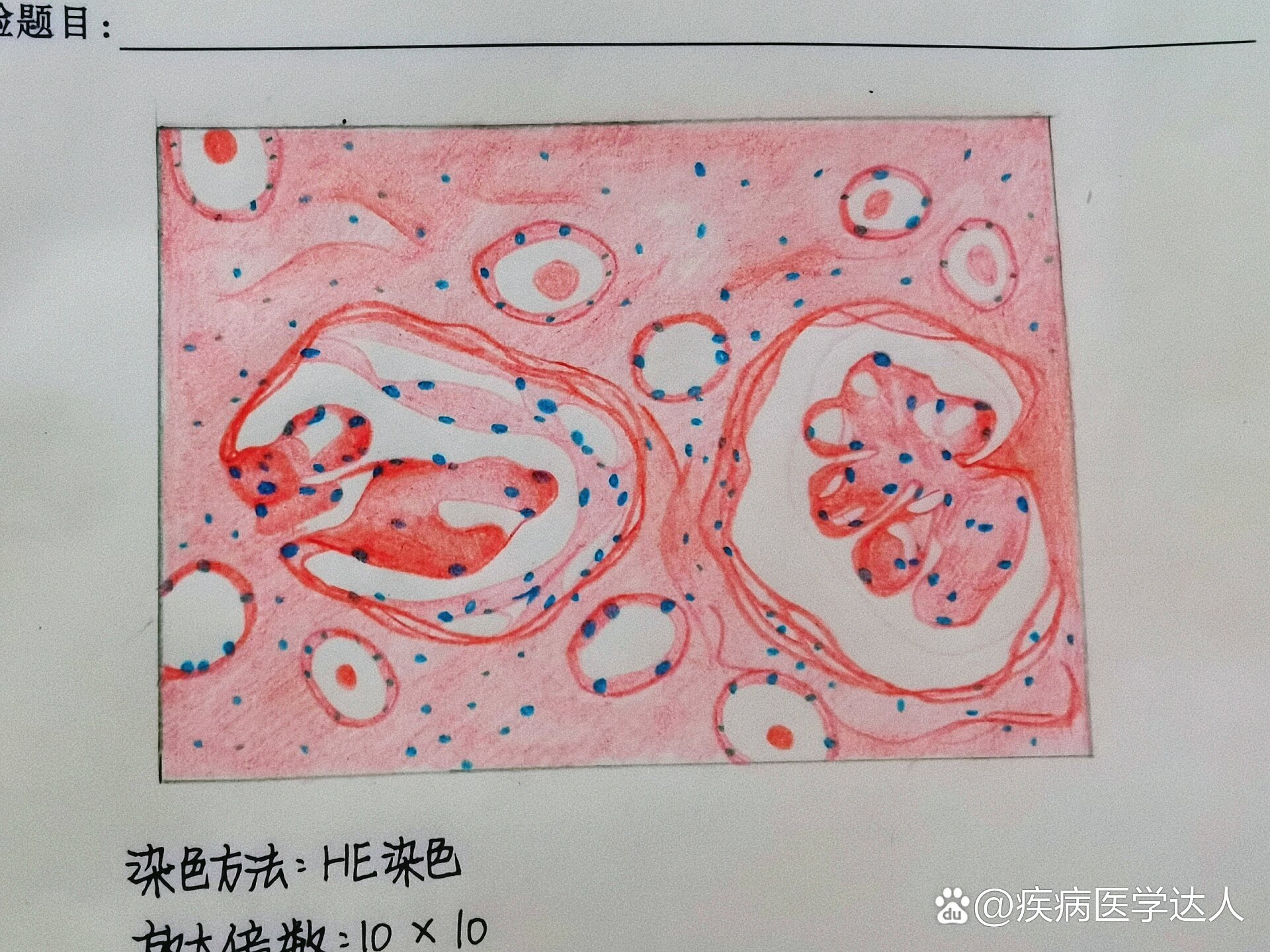 新月体性肾小球肾炎