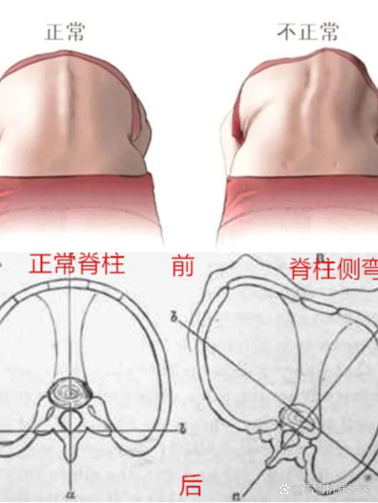 "剃刀背"是如何形成的?