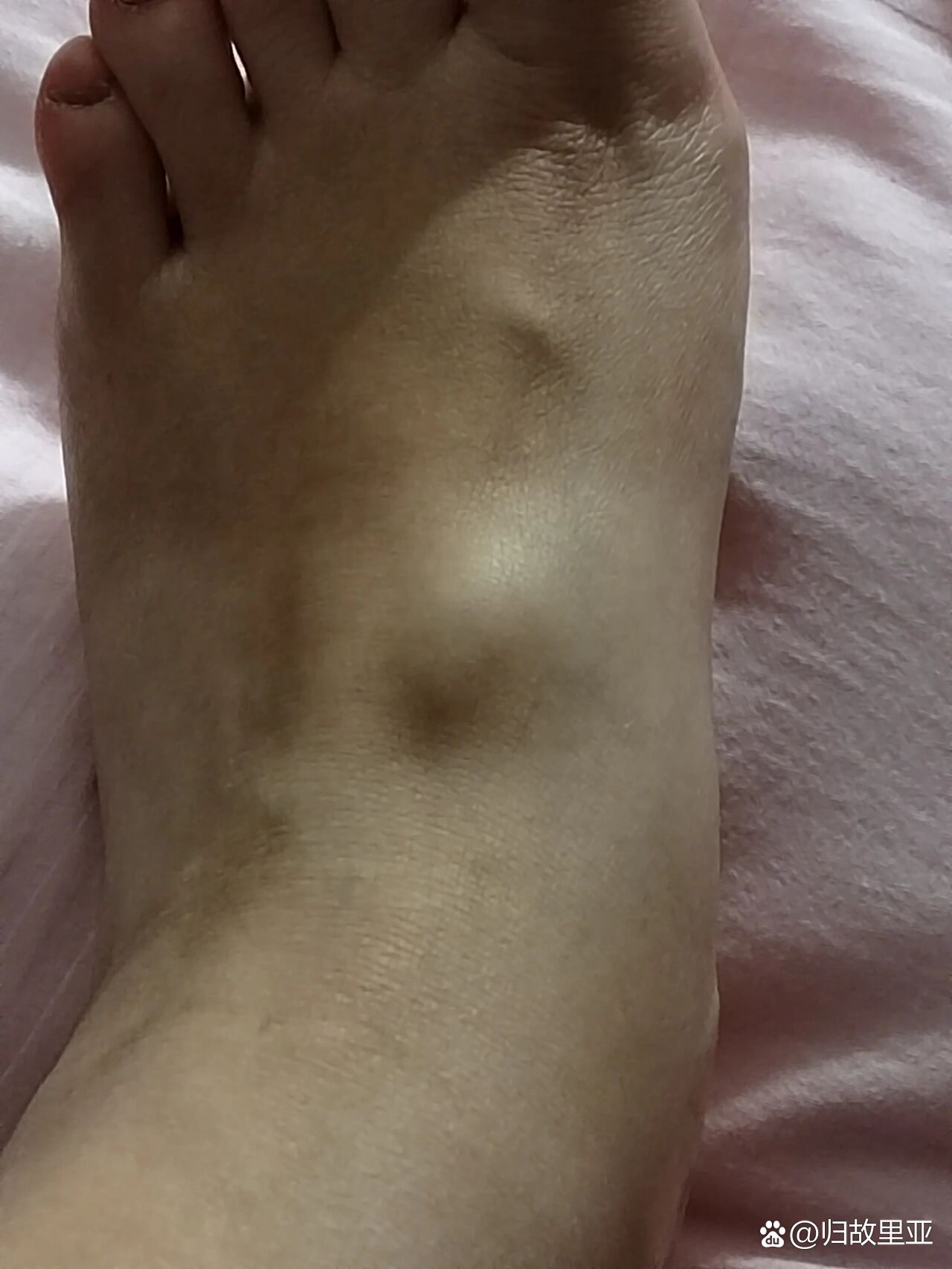 脚背上起了一个大包
