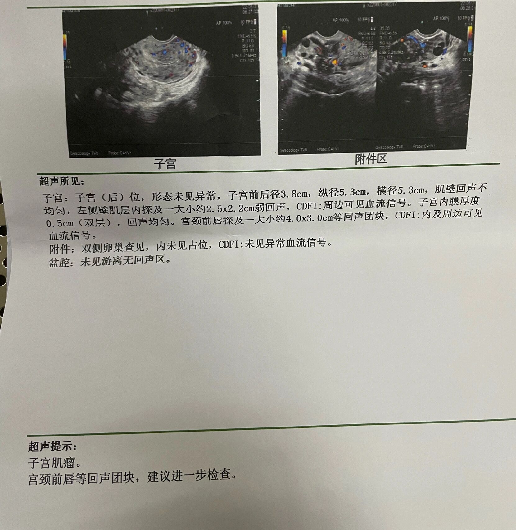 子宫肌瘤 宫颈肌瘤 很多息肉的宫腔镜手术