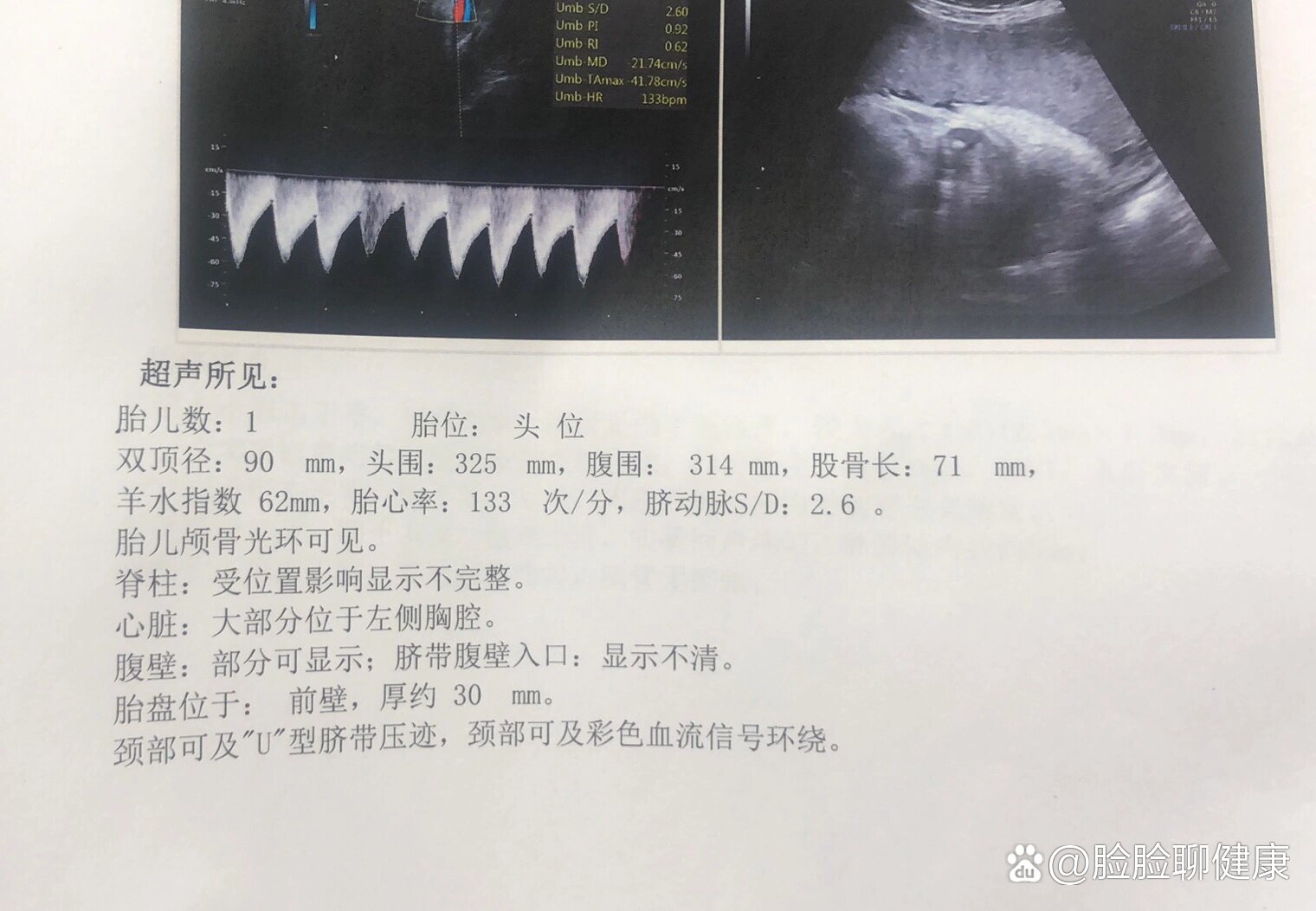 孕36周羊水指数图片